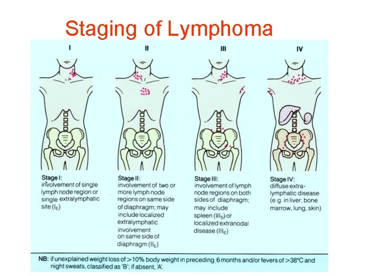 Staging of Lymphoma 