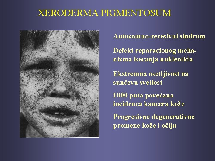 XERODERMA PIGMENTOSUM Autozomno-recesivni sindrom Defekt reparacionog mehanizma isecanja nukleotida Ekstremna osetljivost na sunčevu svetlost