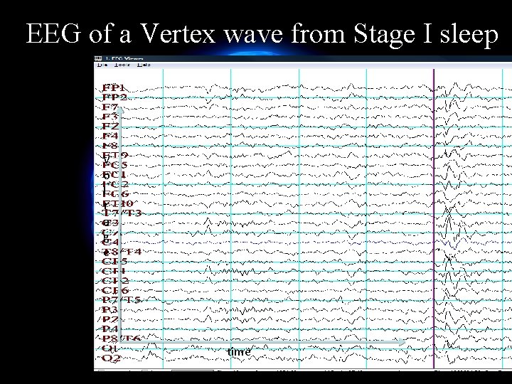 EEG of a Vertex wave from Stage I sleep V o l t a