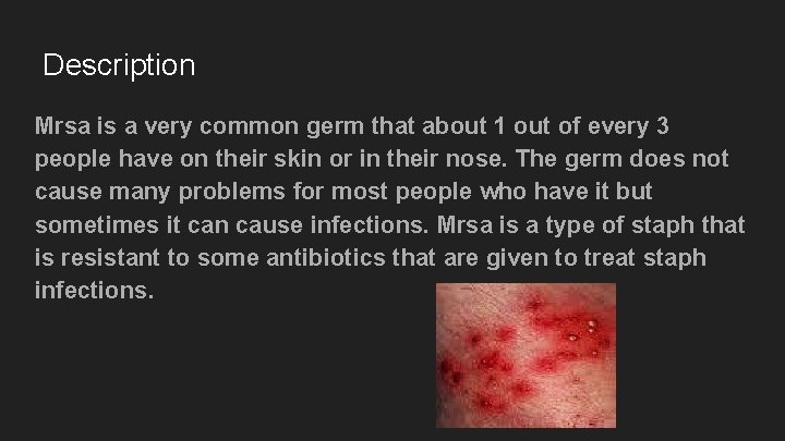 Description Mrsa is a very common germ that about 1 out of every 3