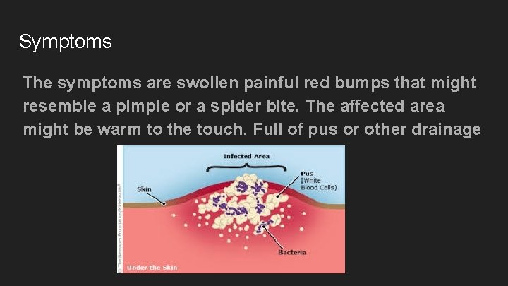 Symptoms The symptoms are swollen painful red bumps that might resemble a pimple or
