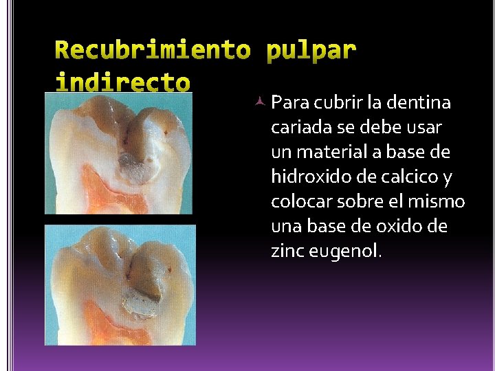  Para cubrir la dentina cariada se debe usar un material a base de