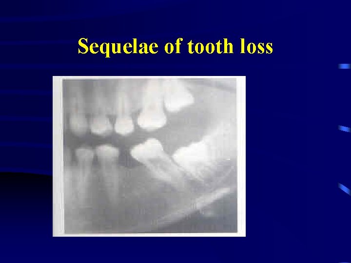 Sequelae of tooth loss 