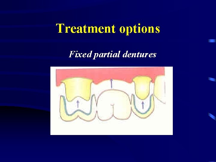 Treatment options Fixed partial dentures 