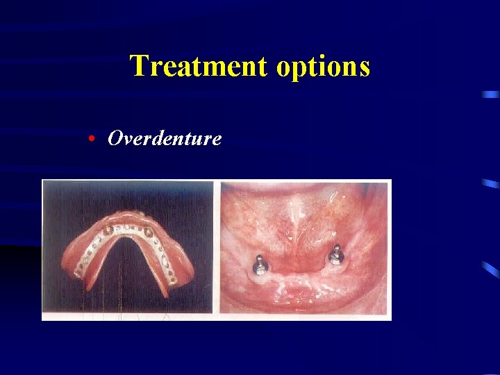 Treatment options • Overdenture 