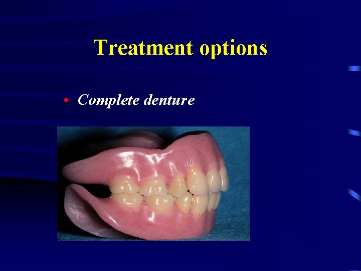 Treatment options • Complete denture 