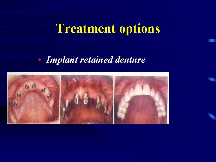 Treatment options • Implant retained denture 