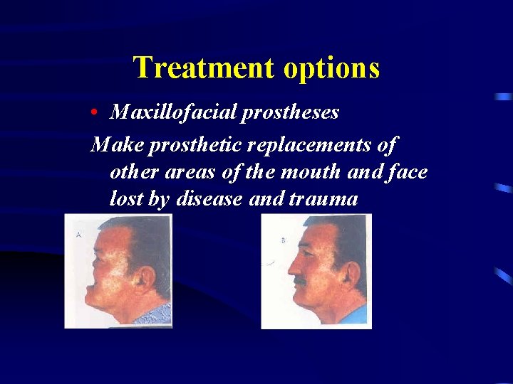Treatment options • Maxillofacial prostheses Make prosthetic replacements of other areas of the mouth