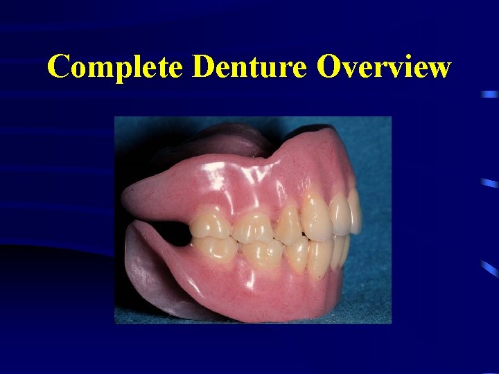 Complete Denture Overview 