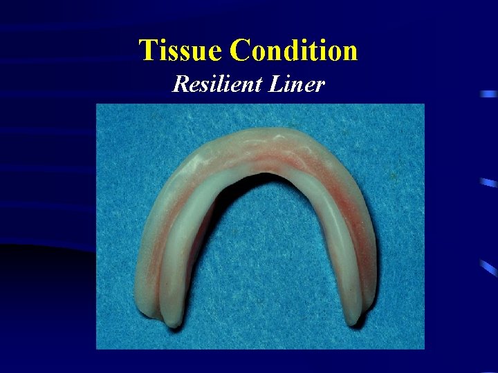 Tissue Condition Resilient Liner 