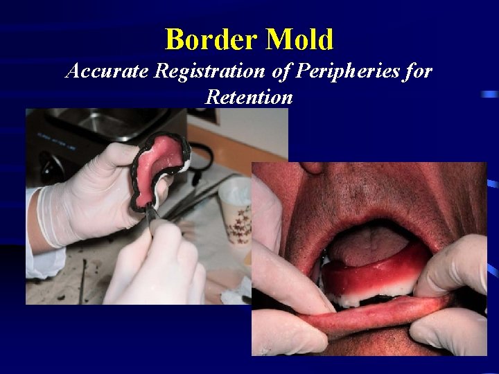 Border Mold Accurate Registration of Peripheries for Retention 