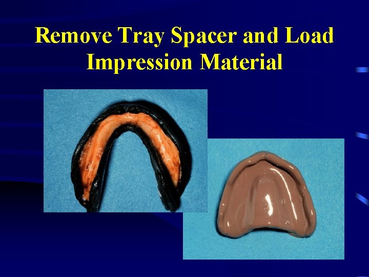 Remove Tray Spacer and Load Impression Material 