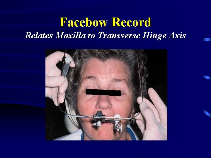 Facebow Record Relates Maxilla to Transverse Hinge Axis 