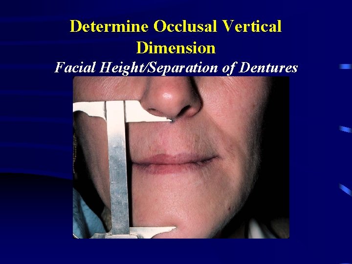 Determine Occlusal Vertical Dimension Facial Height/Separation of Dentures 