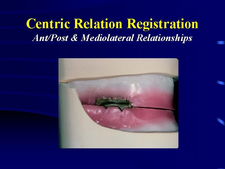 Centric Relation Registration Ant/Post & Mediolateral Relationships 