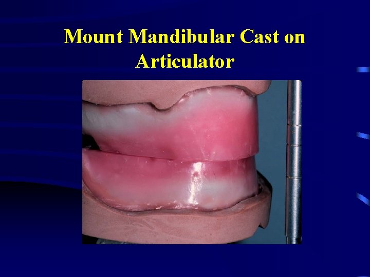 Mount Mandibular Cast on Articulator 