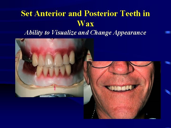 Set Anterior and Posterior Teeth in Wax Ability to Visualize and Change Appearance 