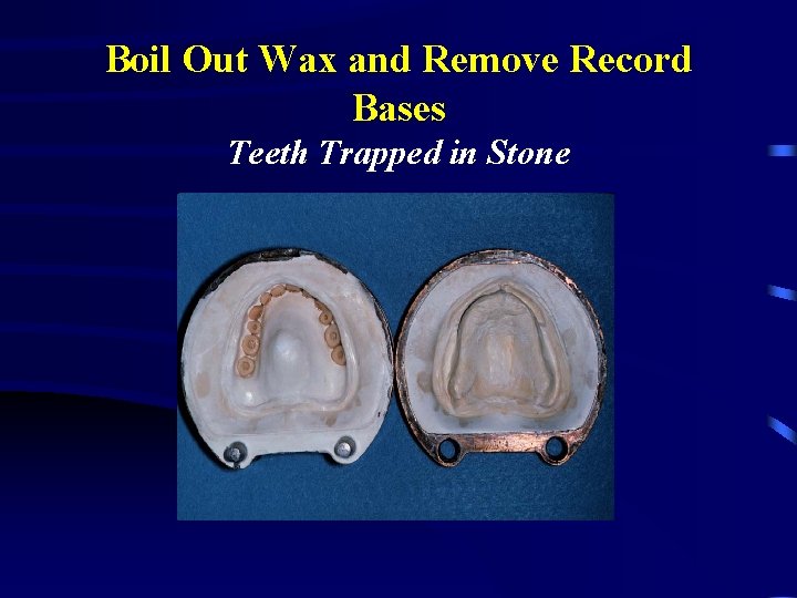 Boil Out Wax and Remove Record Bases Teeth Trapped in Stone 