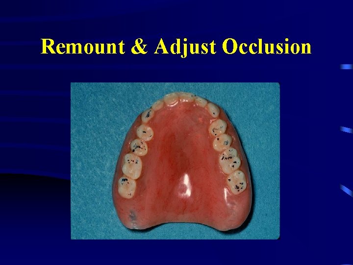 Remount & Adjust Occlusion 