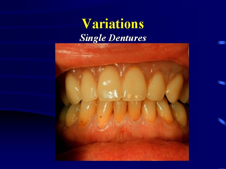 Variations Single Dentures 