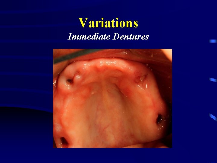 Variations Immediate Dentures 