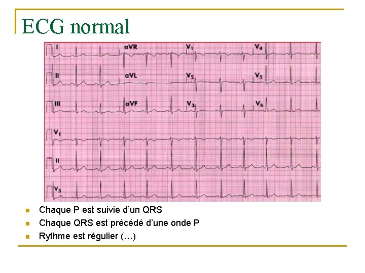 ECG normal n n n Chaque P est suivie d’un QRS Chaque QRS est