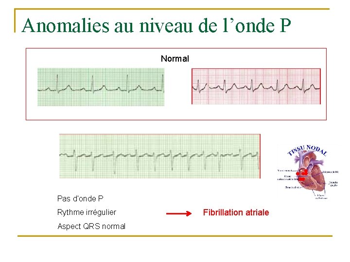 Anomalies au niveau de l’onde P Normal Pas d’onde P Rythme irrégulier Aspect QRS
