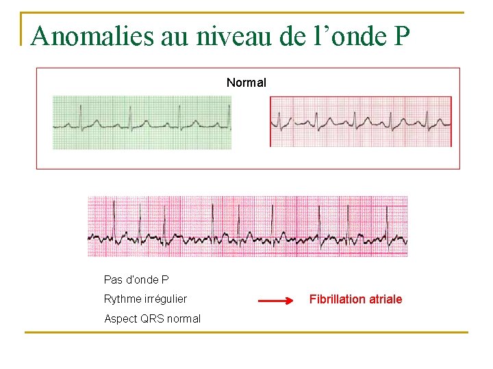 Anomalies au niveau de l’onde P Normal Pas d’onde P Rythme irrégulier Aspect QRS