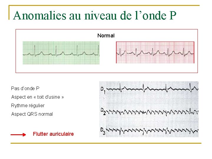 Anomalies au niveau de l’onde P Normal Pas d’onde P Aspect en « toit