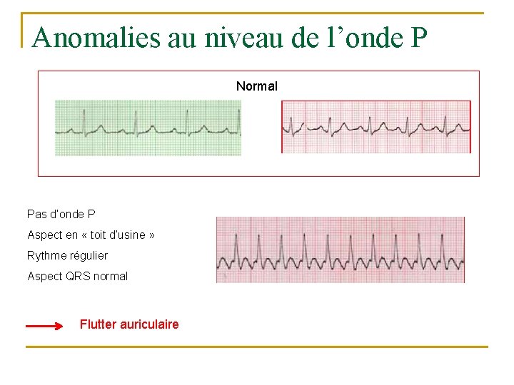 Anomalies au niveau de l’onde P Normal Pas d’onde P Aspect en « toit