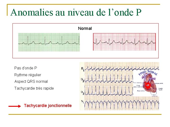 Anomalies au niveau de l’onde P Normal Pas d’onde P Rythme régulier Aspect QRS