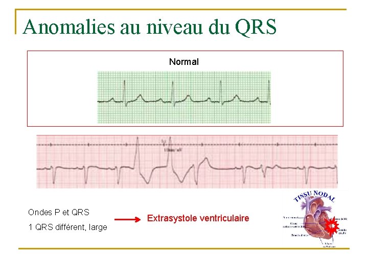 Anomalies au niveau du QRS Normal Ondes P et QRS 1 QRS différent, large