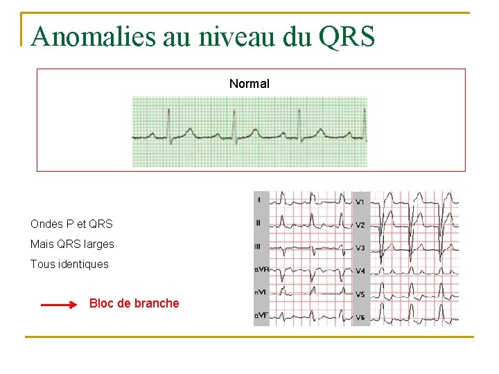 Anomalies au niveau du QRS Normal Ondes P et QRS Mais QRS larges Tous