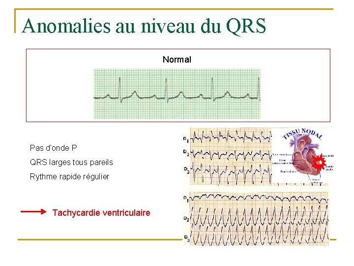 Anomalies au niveau du QRS Normal Pas d’onde P QRS larges tous pareils Rythme