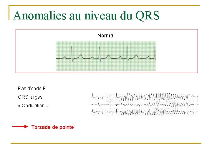 Anomalies au niveau du QRS Normal Pas d’onde P QRS larges « Ondulation »