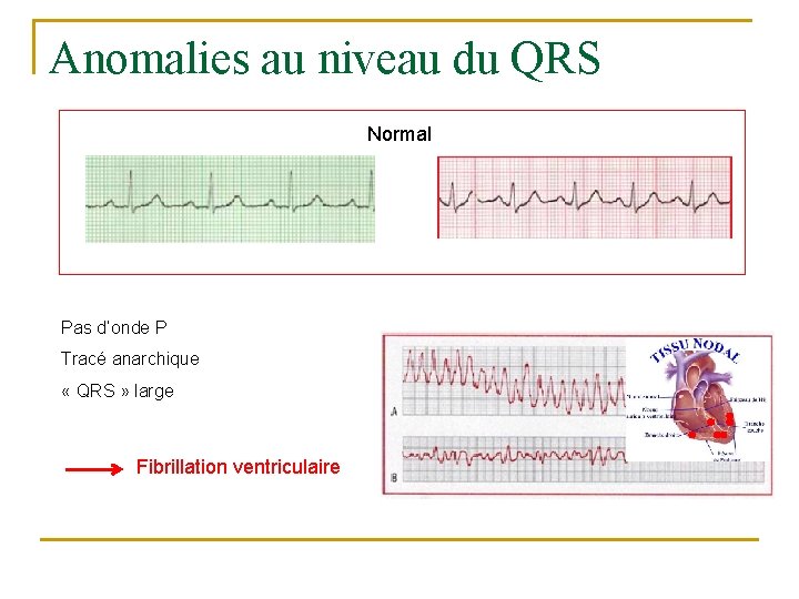 Anomalies au niveau du QRS Normal Pas d’onde P Tracé anarchique « QRS »