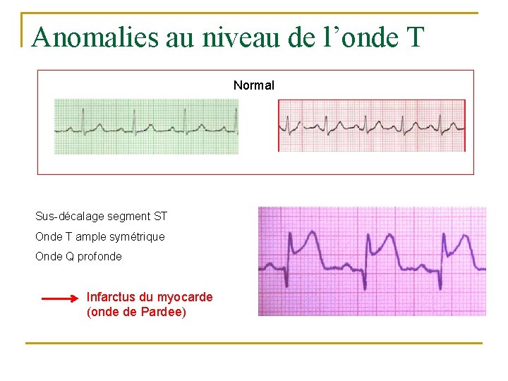 Anomalies au niveau de l’onde T Normal Sus-décalage segment ST Onde T ample symétrique