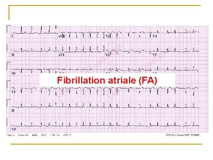 Fibrillation atriale (FA) 