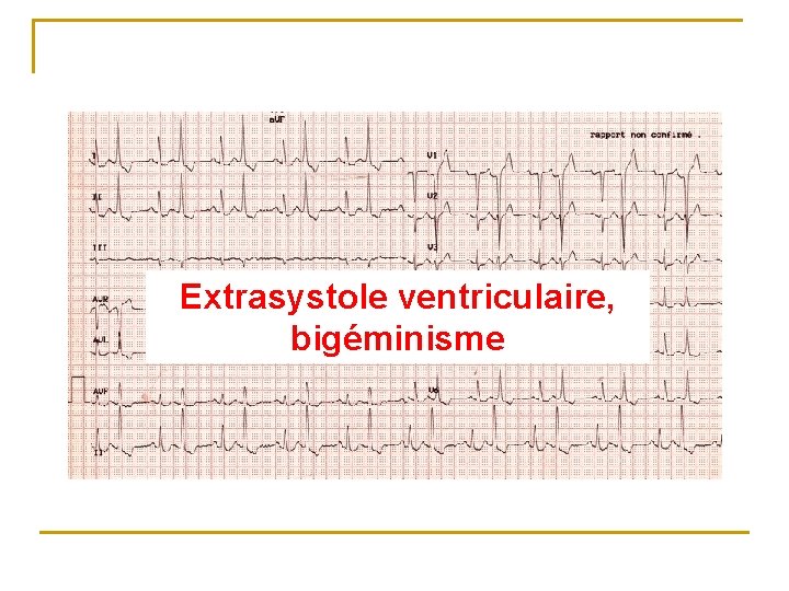 Extrasystole ventriculaire, bigéminisme 