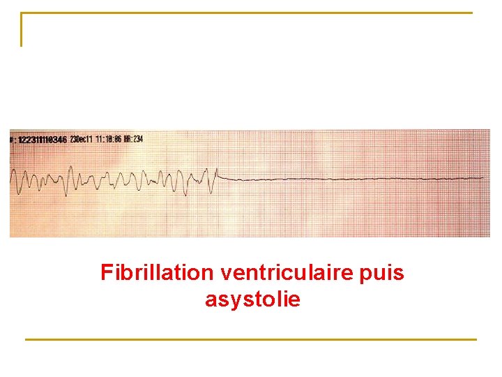 Fibrillation ventriculaire puis asystolie 