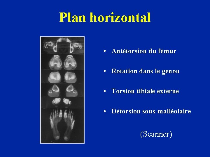 Plan horizontal • Antétorsion du fémur • Rotation dans le genou • Torsion tibiale