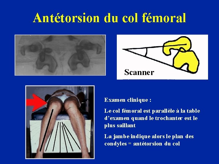 Antétorsion du col fémoral Scanner Examen clinique : Le col fémoral est parallèle à