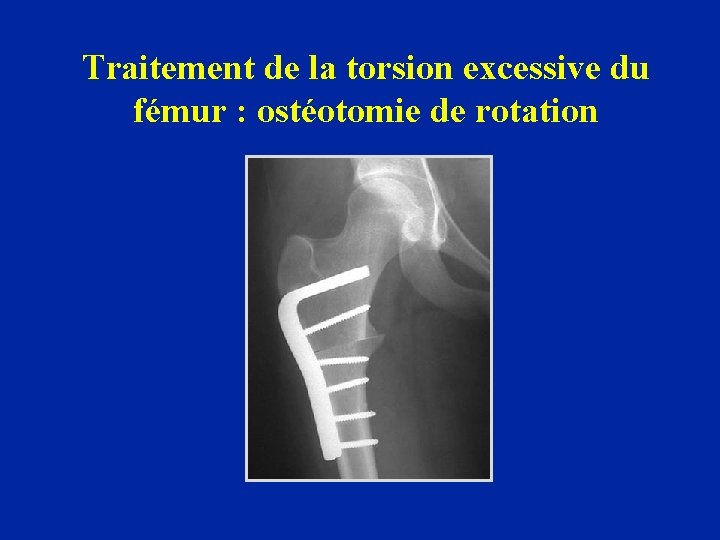 Traitement de la torsion excessive du fémur : ostéotomie de rotation 