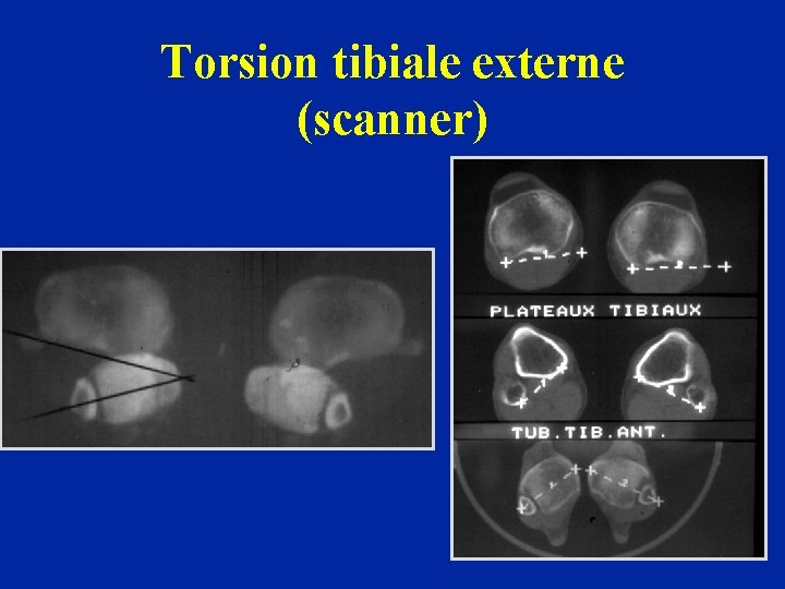 Torsion tibiale externe (scanner) 