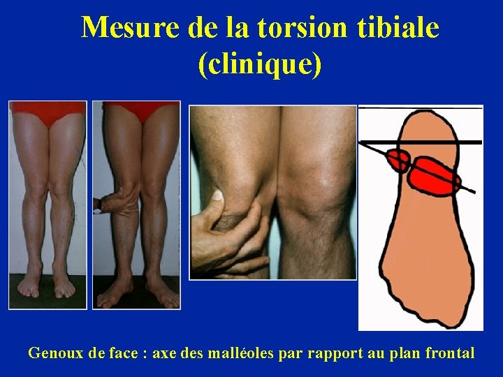 Mesure de la torsion tibiale (clinique) Genoux de face : axe des malléoles par