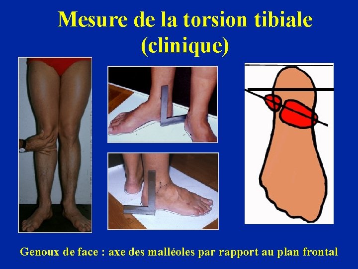Mesure de la torsion tibiale (clinique) Genoux de face : axe des malléoles par