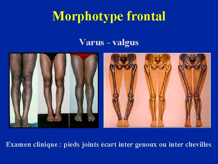 Morphotype frontal Varus - valgus Examen clinique : pieds joints écart inter genoux ou