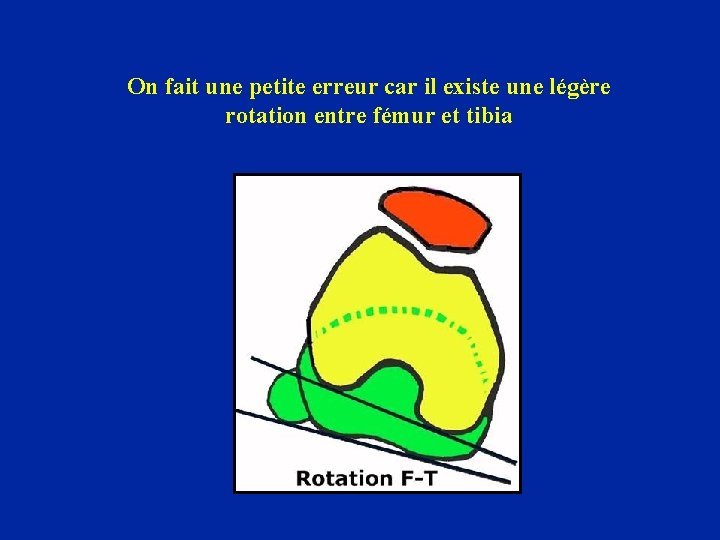On fait une petite erreur car il existe une légère rotation entre fémur et