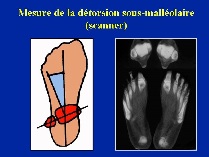 Mesure de la détorsion sous-malléolaire (scanner) 