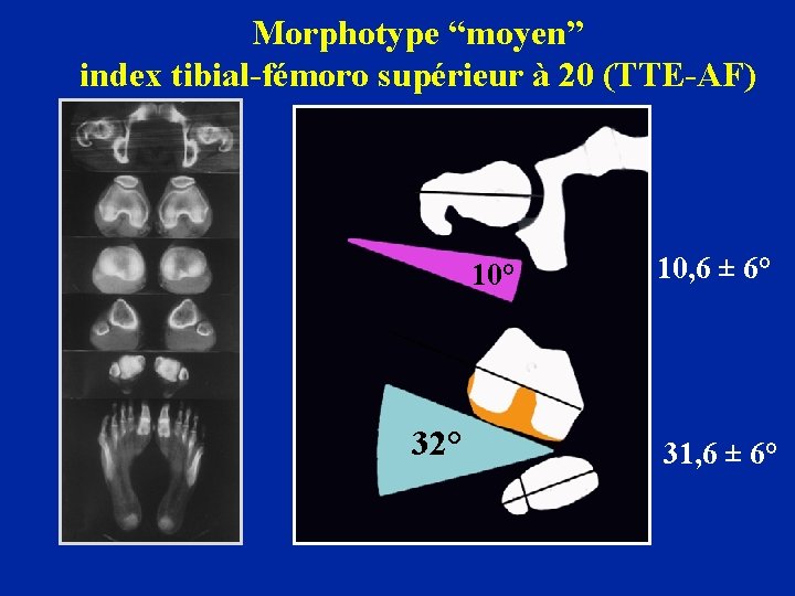 Morphotype “moyen” index tibial-fémoro supérieur à 20 (TTE-AF) 10° 32° 10, 6 ± 6°